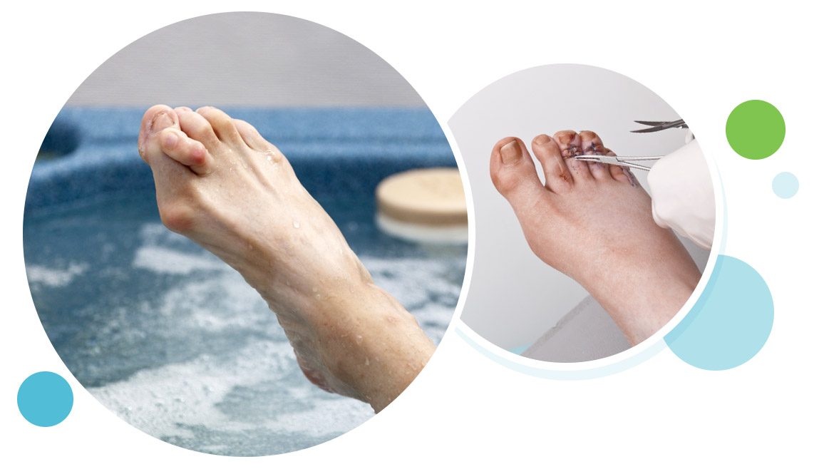 Hammer Toe Surgery and Comprehensive Treatment