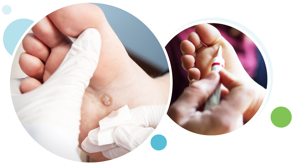 pulling out plantar wart root