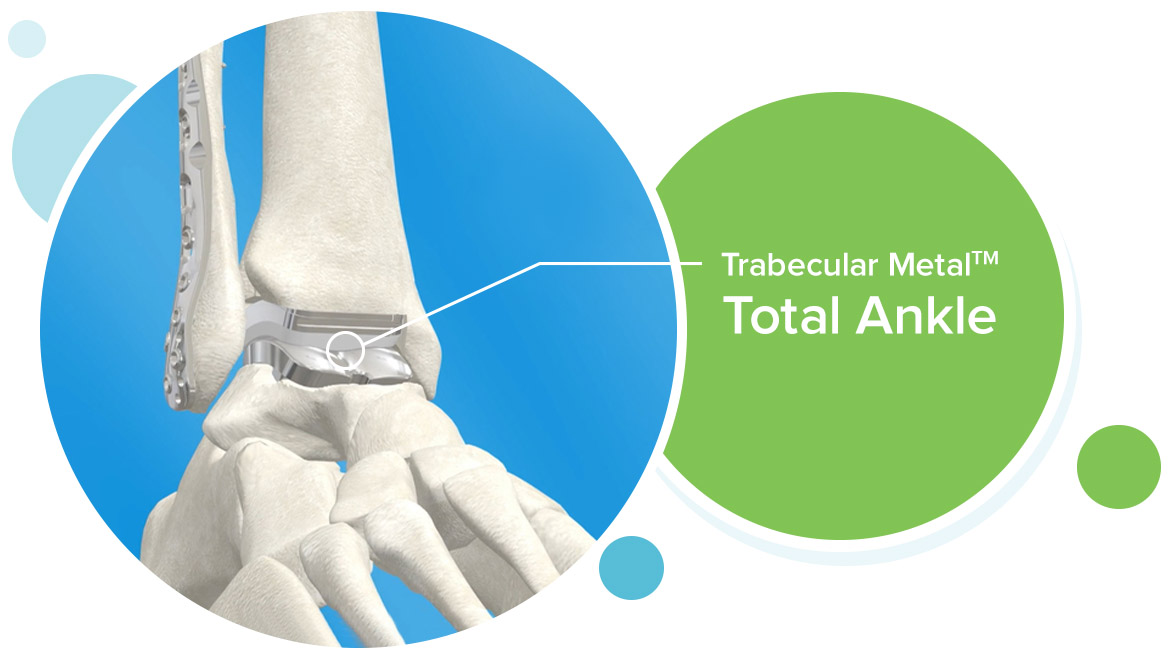 Trabecular Metal Total Ankle
